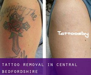 Tattoo Removal in Central Bedfordshire