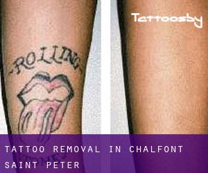 Tattoo Removal in Chalfont Saint Peter
