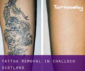 Tattoo Removal in Challoch (Scotland)