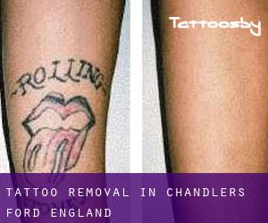 Tattoo Removal in Chandler's Ford (England)