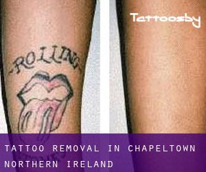 Tattoo Removal in Chapeltown (Northern Ireland)