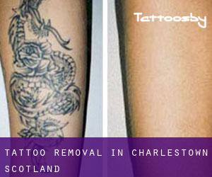 Tattoo Removal in Charlestown (Scotland)