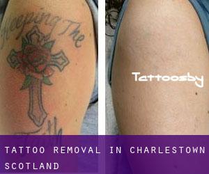 Tattoo Removal in Charlestown (Scotland)