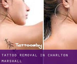 Tattoo Removal in Charlton Marshall