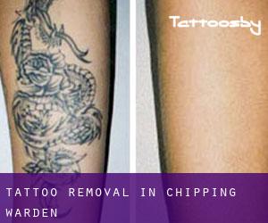 Tattoo Removal in Chipping Warden