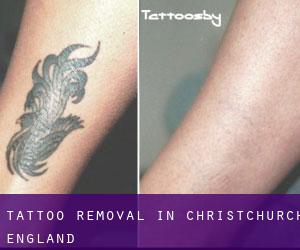 Tattoo Removal in Christchurch (England)