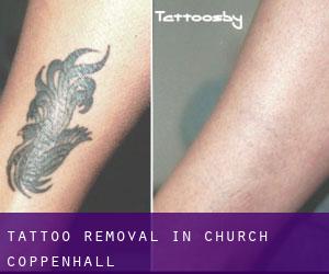 Tattoo Removal in Church Coppenhall