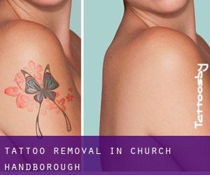 Tattoo Removal in Church Handborough