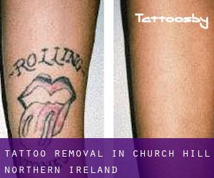 Tattoo Removal in Church Hill (Northern Ireland)