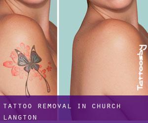 Tattoo Removal in Church Langton