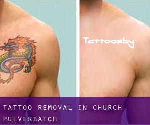 Tattoo Removal in Church Pulverbatch