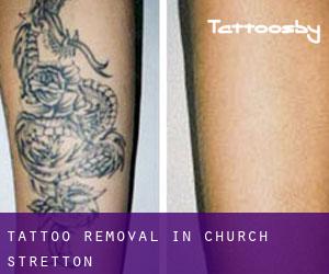 Tattoo Removal in Church Stretton