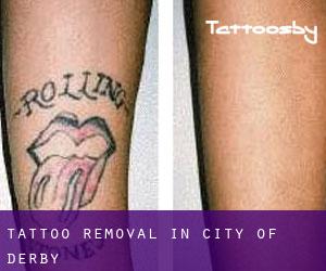 Tattoo Removal in City of Derby