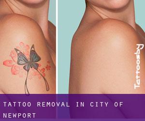 Tattoo Removal in City of Newport