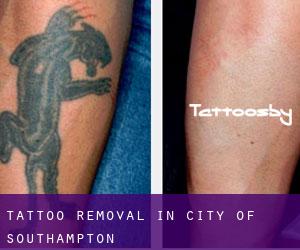 Tattoo Removal in City of Southampton