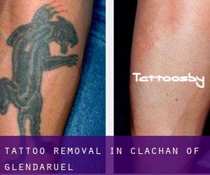 Tattoo Removal in Clachan of Glendaruel