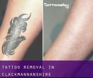 Tattoo Removal in Clackmannanshire