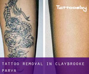 Tattoo Removal in Claybrooke Parva