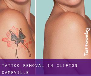 Tattoo Removal in Clifton Campville