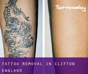 Tattoo Removal in Clifton (England)