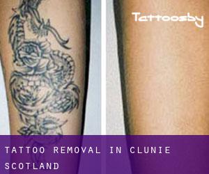 Tattoo Removal in Clunie (Scotland)