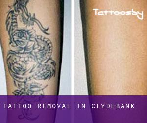 Tattoo Removal in Clydebank