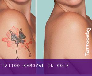 Tattoo Removal in Cole
