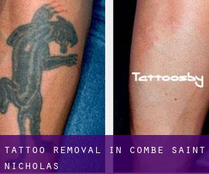 Tattoo Removal in Combe Saint Nicholas
