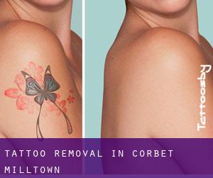 Tattoo Removal in Corbet Milltown