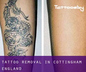 Tattoo Removal in Cottingham (England)