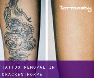 Tattoo Removal in Crackenthorpe