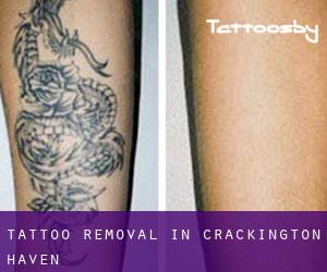 Tattoo Removal in Crackington Haven