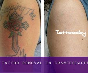 Tattoo Removal in Crawfordjohn