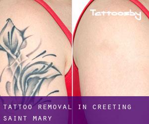 Tattoo Removal in Creeting Saint Mary