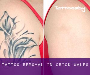 Tattoo Removal in Crick (Wales)