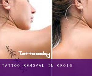 Tattoo Removal in Croig