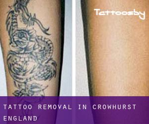 Tattoo Removal in Crowhurst (England)