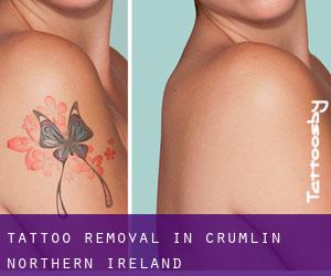 Tattoo Removal in Crumlin (Northern Ireland)