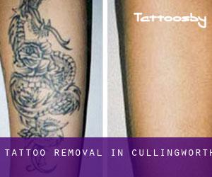 Tattoo Removal in Cullingworth