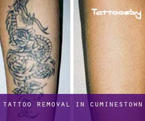 Tattoo Removal in Cuminestown