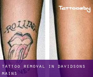 Tattoo Removal in Davidsons Mains