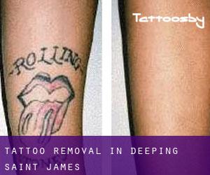 Tattoo Removal in Deeping Saint James