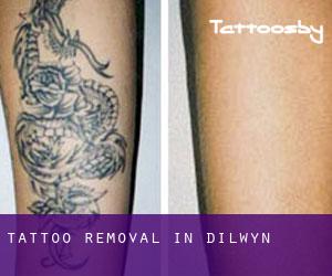 Tattoo Removal in Dilwyn