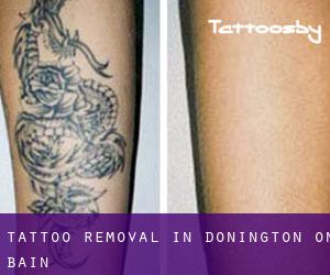 Tattoo Removal in Donington on Bain