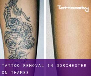 Tattoo Removal in Dorchester on Thames