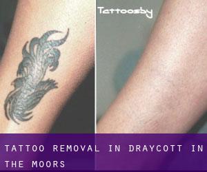 Tattoo Removal in Draycott in the Moors