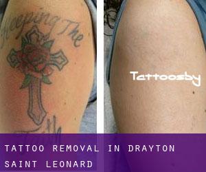 Tattoo Removal in Drayton Saint Leonard