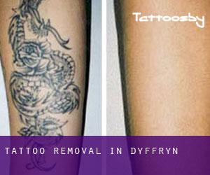 Tattoo Removal in Dyffryn