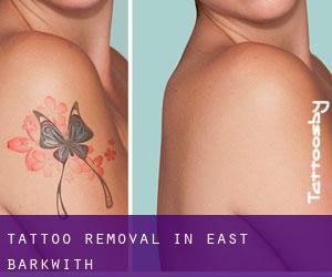 Tattoo Removal in East Barkwith