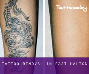Tattoo Removal in East Halton